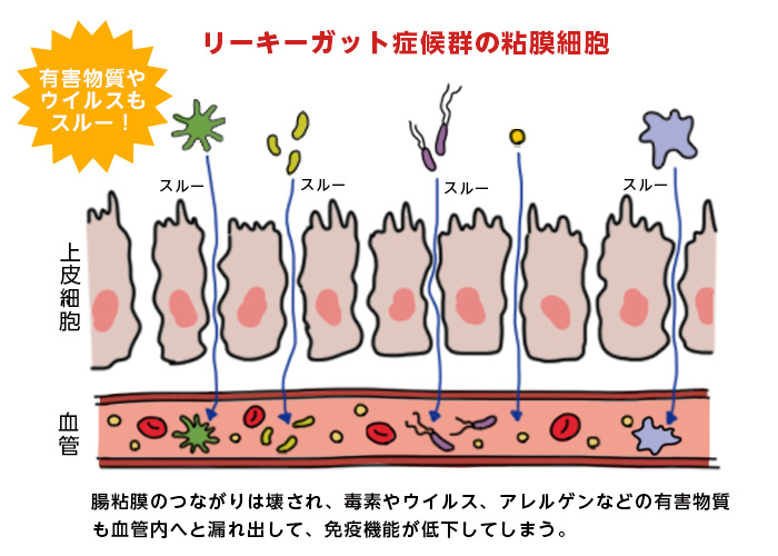 リーキーガット症候群（腸もれ？）あなたは大丈夫？！ | 藤田紘一郎先生に聞く「腸大切なお話」